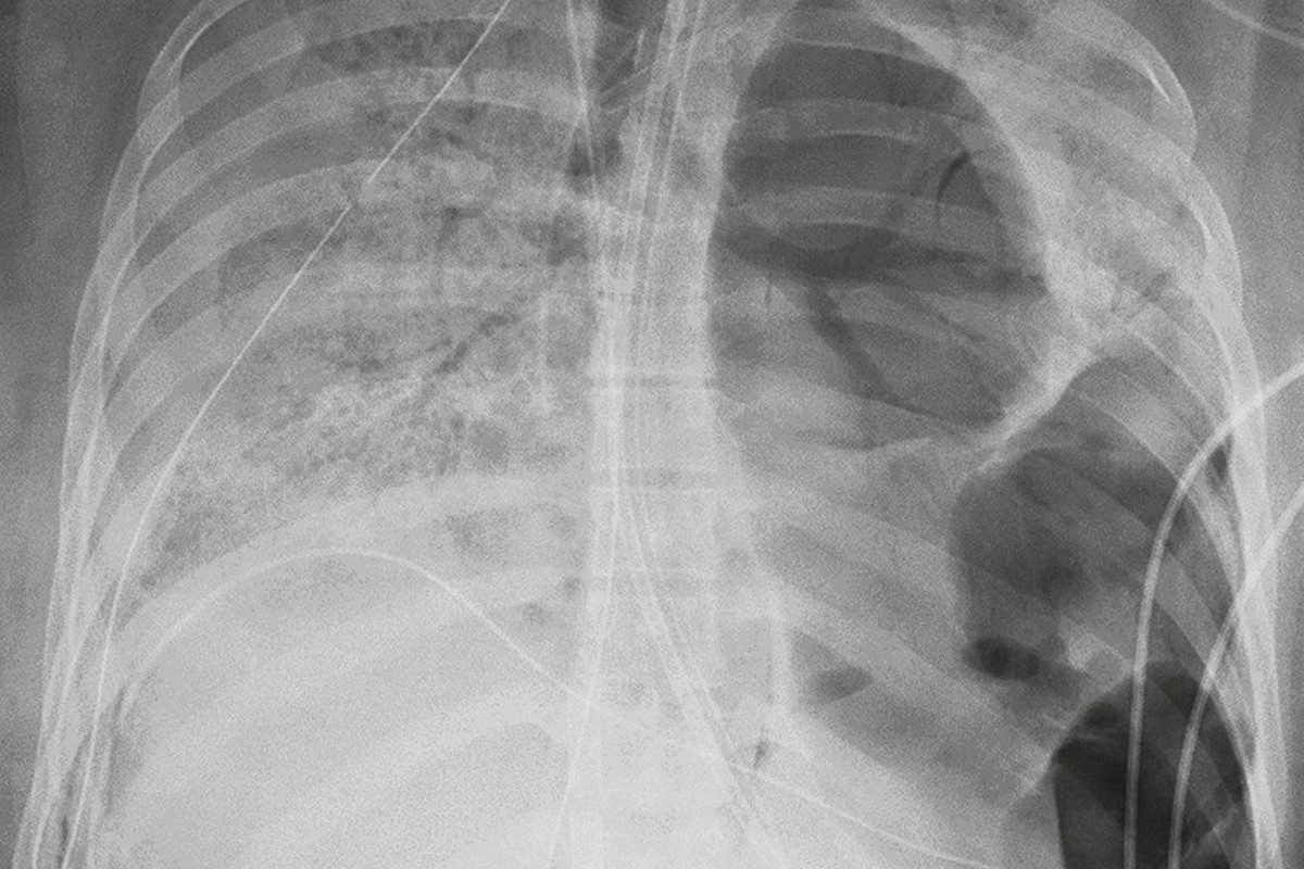 Lung Transplant Performed in COVID-19 Patient