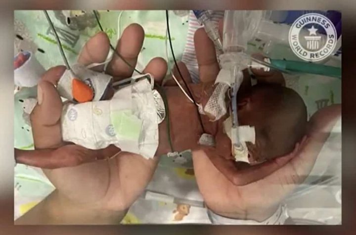 Born at 21 weeks, he became the youngest premature baby in the world