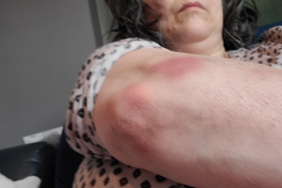 On August 15, Monique Mercier photographed her wounds with police intervention. 