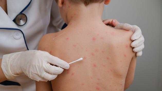 Chickenpox and shingles, a virus for two different diseases