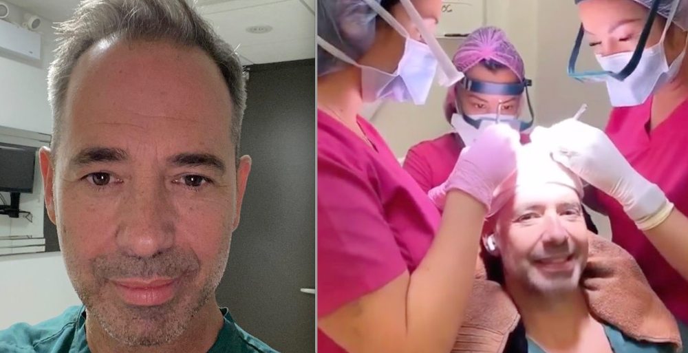 Jose Gaudet has gone out and shared all the photos of his hair transplant